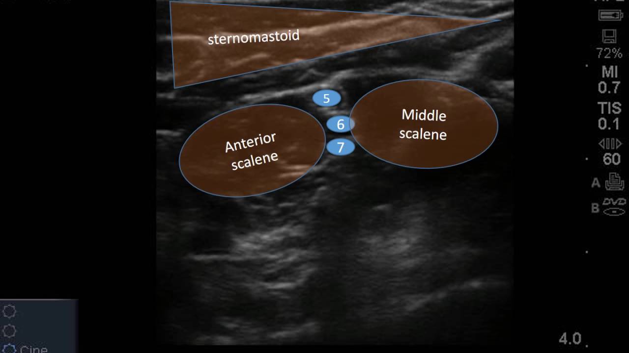 Interscalene Block at Triage for Shoulder Dislocation - YouTube