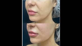 Безоперационный SMAS-лифтинг  на аппарате  Ultraformer .#хабаровск#VG_clinic