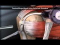 Тенодез сухожилия длинной головки бицепса (Proximal Biceps Repair using SwiveLock Tenodesis)