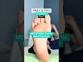 Metatarsal Pad #footpain #footpainrelief #padding #podiatry #doctor