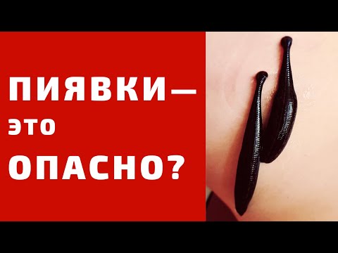 Осложнения гирудотерапии. Опасны ли пиявки?