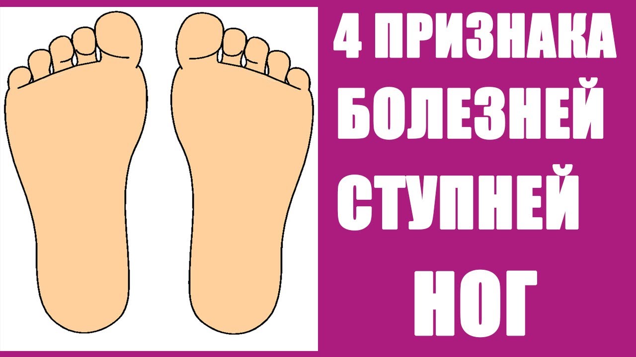 Болезни стопы человека в картинках подошвы