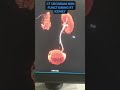 CT Urogram- Non functioning Right kidney #mri #medica#mriscan#radiographer #radiologytechnologist
