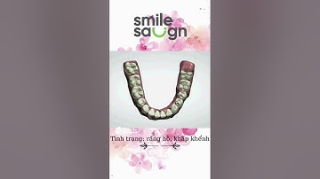 Tổng hợp các phác đồ niềng răng khấp khểnh   Smile Salign Việt Nam