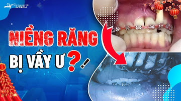 5 Biến Chứng Nguy Hiểm Khi Niềng Răng Bạn Nên Biết | Nha Khoa Lạc Việt Intech