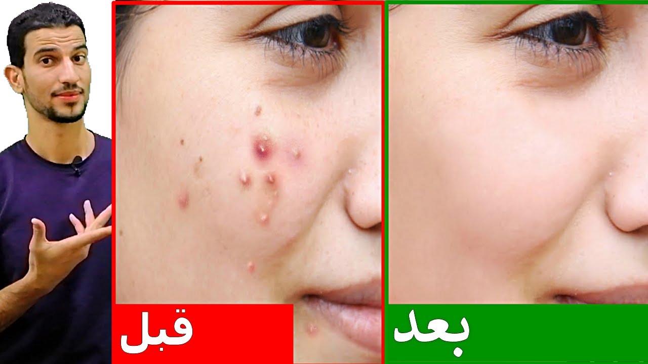 كيف تتخلص من حبوب الشباب للابد !