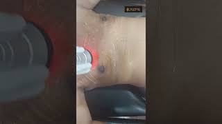 Gynecomastia  RF Session