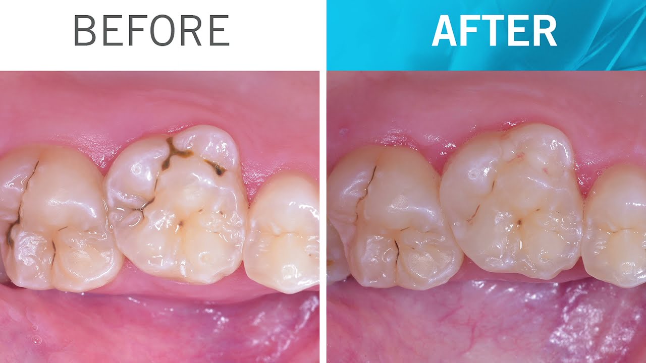 Step by step ONE Shade restoration with Venus Diamond ONE by Edoardo Fossati (EN)