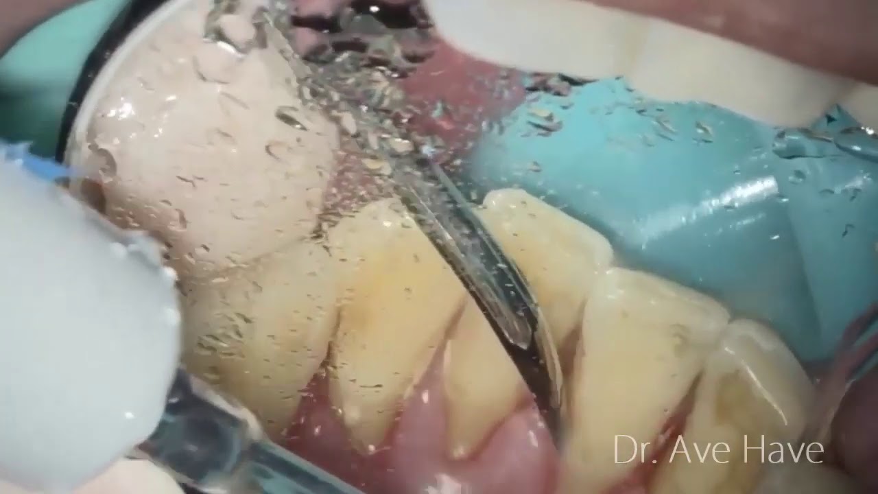 Scaling and Root Planing / Dr. Ave Have