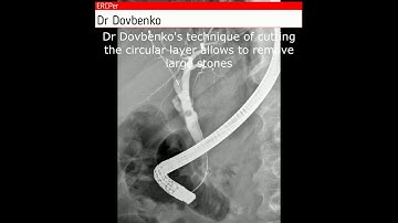 Performing ERCP on a patient with duodenal diverticula