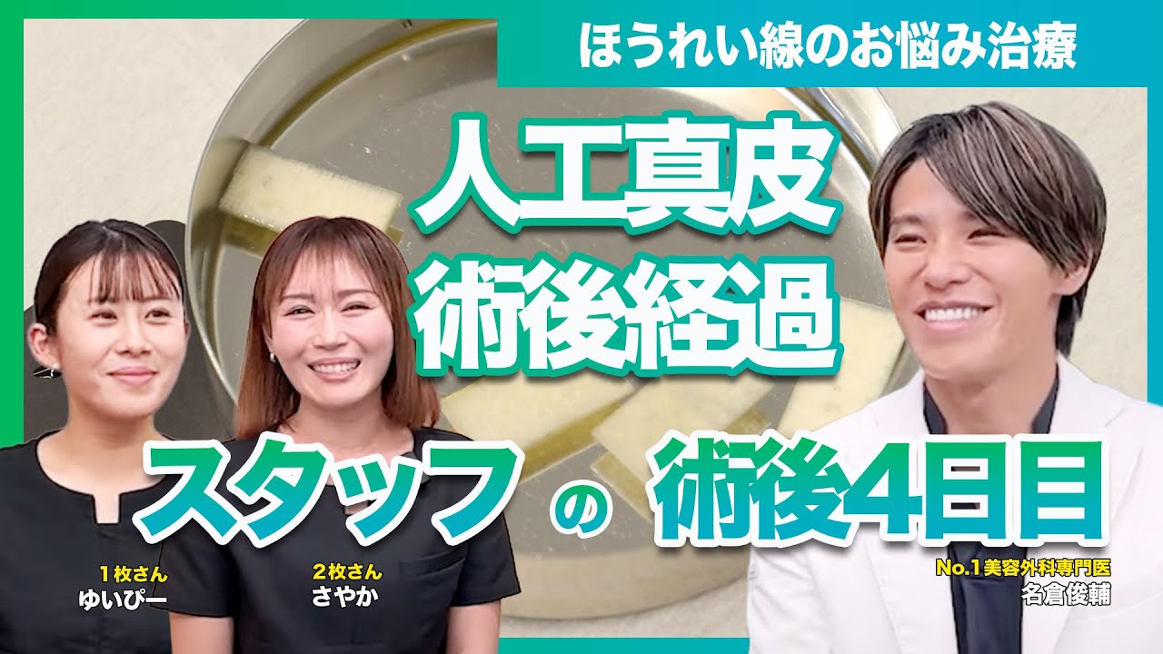 【ほうれい線治療】人工真皮を入れたスタッフの術後4日目の様子｜腫れ・感覚・内出血｜ヒアルロン酸・脂肪注入との違い【対談】