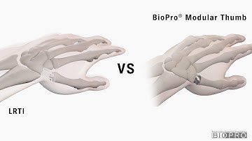 BioPro Modular Thumb Joint Replacement vs Traditional Surgery for Basal Thumb Arthritis