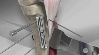 Tibial Tubercle Osteotomy with Arthrex® T3 AMZ System