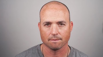 Chris: Before + After Scalp Micro Pigmentation at The Scalp Shop