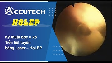 Kỹ thuật bóc u xơ Tiền liệt tuyến bằng Laser – HoLEP (xay hút)
