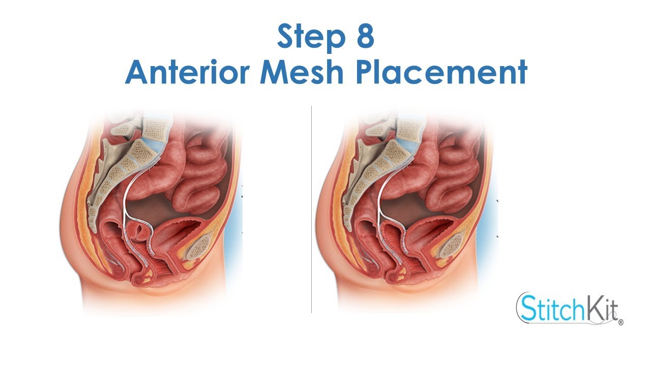 Suturing mesh to anterior vaginal wall - YouTube