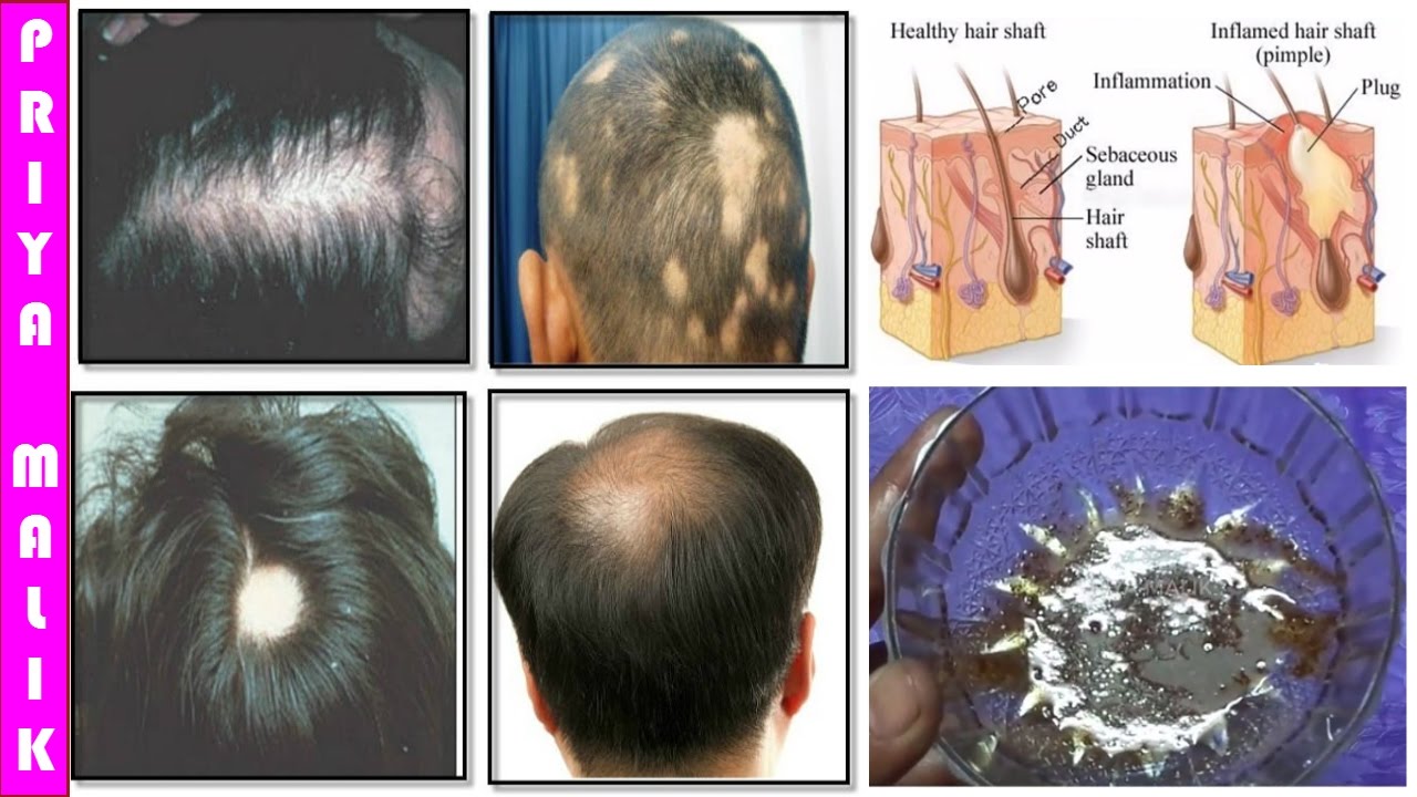 Grow Long Hair 100 Natural Hair Loss Treatment Cure Baldness