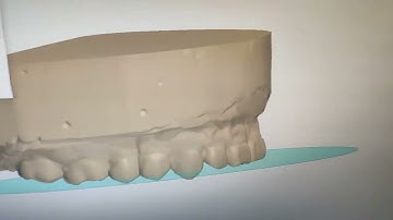 Splint Design in 3Shape Appliance Designer （part 1）