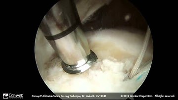 ConMed Linvatec Concept All Inside Suture Passing Technique, Dr. Mehalik M