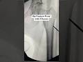 Hip Fracture Fixed with Three Screws | Femoral Neck Fixation