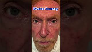 Efudex Treatment Week 1 My Lips Tell The Story