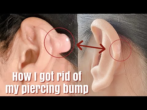 Video: Keloid On Ear: Piercings, Andere Oorzaken, Behandeling, Verwijdering, Preve