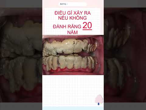 Video Điều gì xảy ra nếu không đánh răng 20 năm ?#foryou... - youtube