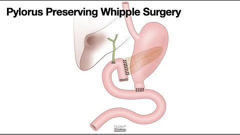 HCC 1475-10f-Surgical Anatomy-Pylorus Preserving Whipple - DayDayNews