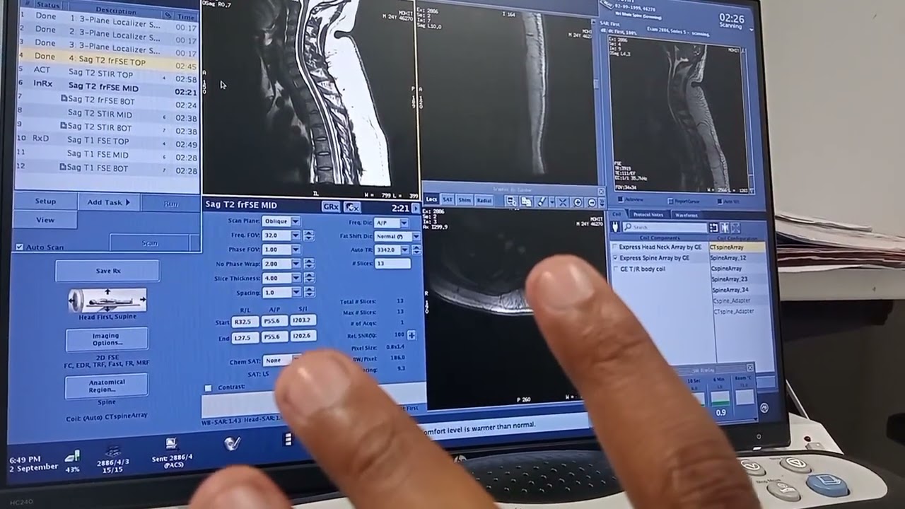 mri whole spine screening