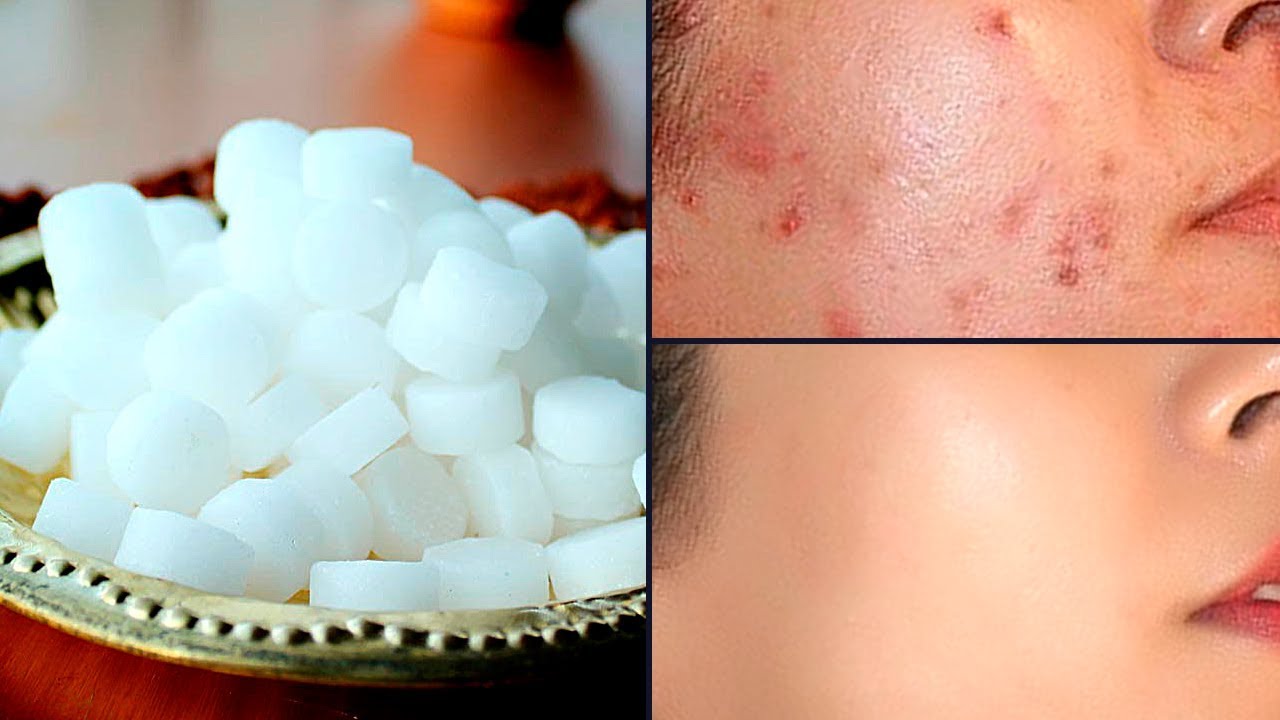 कपूर के चौंकानेवाले फायदे - जाने | Remove Pimples Using Camphor - YouTube