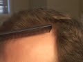 HAIR TRANSPLANT HAIR RESTORATION DALLAS CLOSEUP 4
