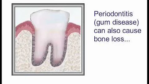 How Tooth Loss Affects You - Anne Nicholas, DDS