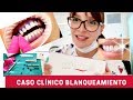 REVIEW: Blanqueamiento Dental de Consultorio YOTUEL + Caso Clínico