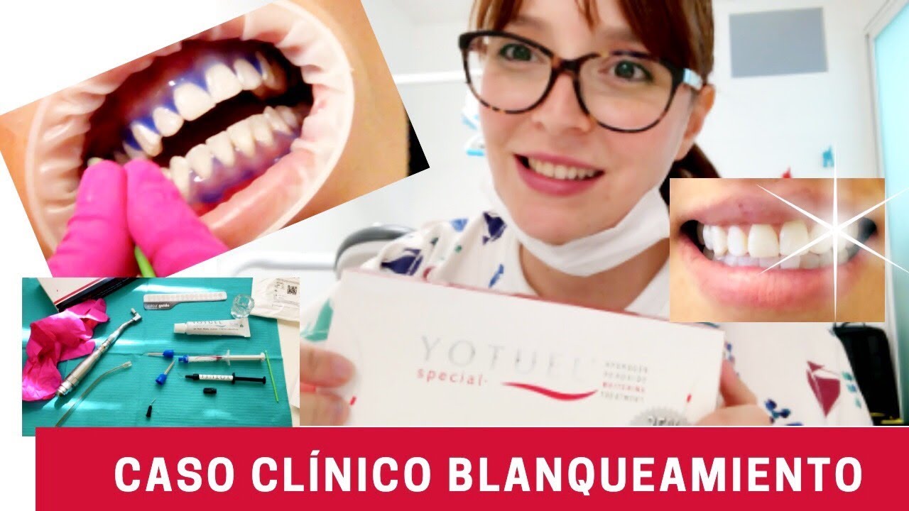 REVIEW: Blanqueamiento Dental de Consultorio YOTUEL + Caso Clínico