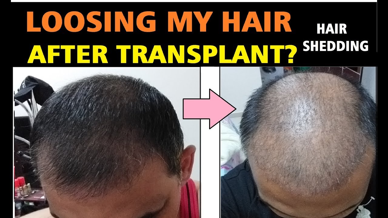 minoxidil-shedding-increased-hair-fall-in-first-month-of-49-off