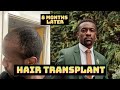 Hair transplant results after 8 months  before  after  daniel asante