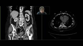 Urothelial neoplasm @yaleradiology