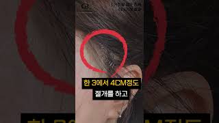 #shorts 거짓말 같은 진짜 미니거상 효과 #송도성형외과 #미니거상