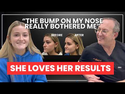 Video thumbnail: Nose Job Transformation That Changed Her Confidence - Plastic Surgeon Interviews Patient! · The Spiegel Center