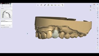 3Shape Zirconia Mamelon Cutback Design 040623