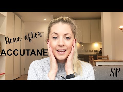 ACNE AFTER ACCUTANE + TIPS TO STAY CLEAR
