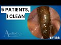 Unbelievable Ear Wax Removal – Huge Keratin & Sticky Plugs - EP1198