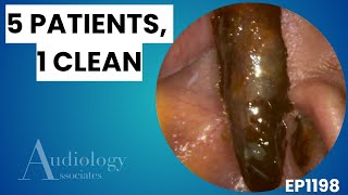 Extreme Ear Wax Removal Compilation | 5 Patients Deep Ear Clean - EP1198