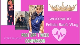 Post BBL day 1 vs day 7 with results cg cosmetic surgery dr carvalho