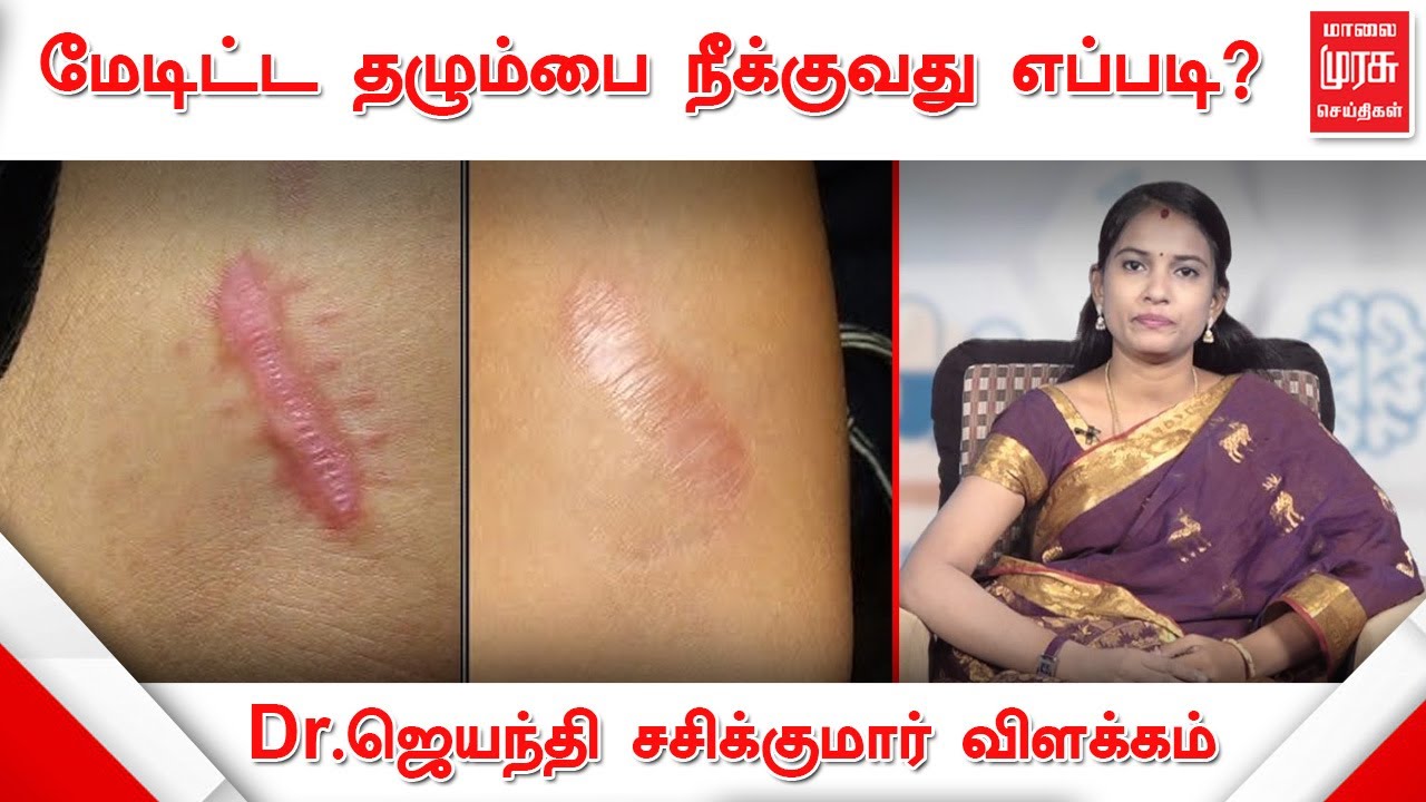 மேடிட்ட தழும்பை நீக்குவது எப்படி? விளக்குகிறார் மருத்துவர் ஜெயந்தி
