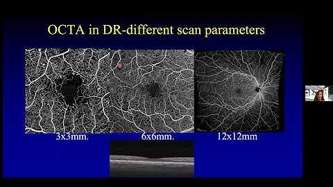 OCT-A Imaging to Identify Proliferative Diabetic Retinopathy