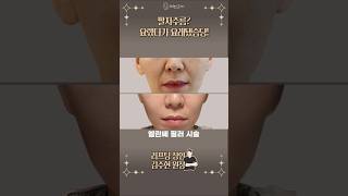 팔자주름 없애는 시술 전후 공개! #팔자주름 #실리프팅잘하는곳 #팔자필러 #실리프팅전문 #shorts