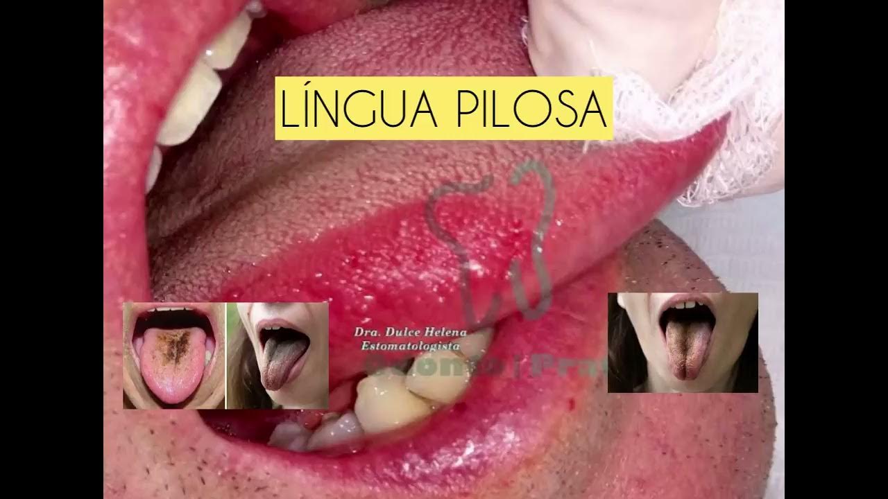 LÍNGUA PILOSA - PATOLOGIA ORAL - cabelos na língua - YouTube
