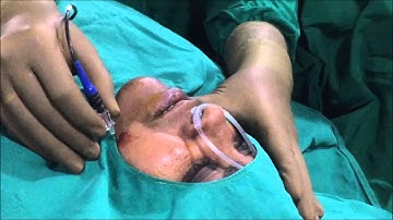 Radiofrequency ablation of Gasserian Ganglion for Trigeminal Neuralgia