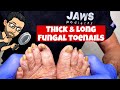 LONG TOENAILS DEBRIDEMENT (6 MONTHS OLD NO CUT)